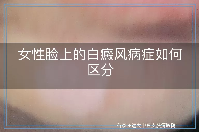 女性脸上的白癜风病症如何区分