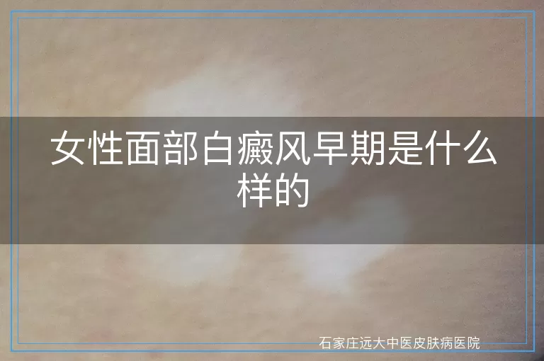 女性面部白癜风早期是什么样的