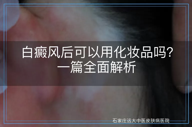 白癜风后可以用化妆品吗？一篇全面解析