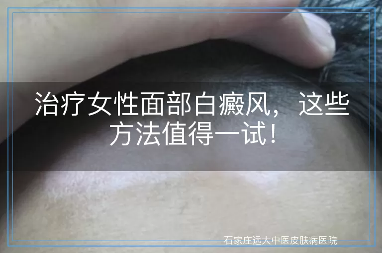 治疗女性面部白癜风，这些方法值得一试！