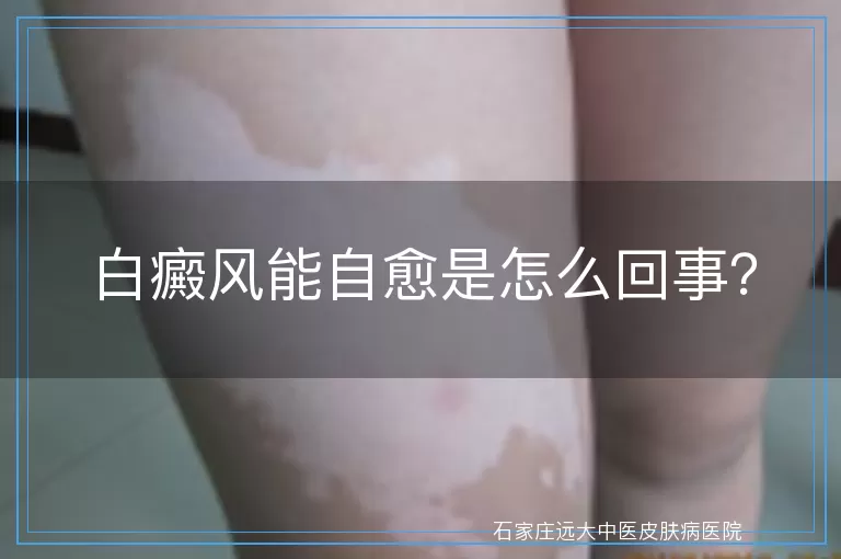 白癜风能自愈是怎么回事？