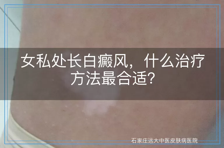 女私处长白癜风，什么治疗方法最合适？