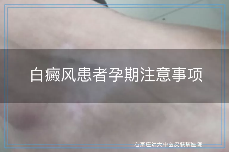 白癜风患者孕期注意事项