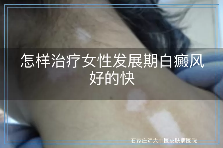 怎样治疗女性发展期白癜风好的快