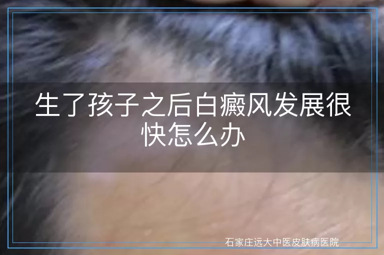 生了孩子之后白癜风发展很快怎么办
