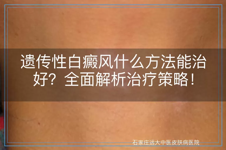 遗传性白癜风什么方法能治好？全面解析治疗策略！