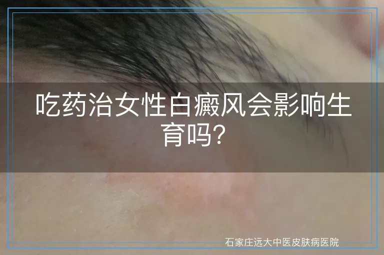吃药治女性白癜风会影响生育吗？