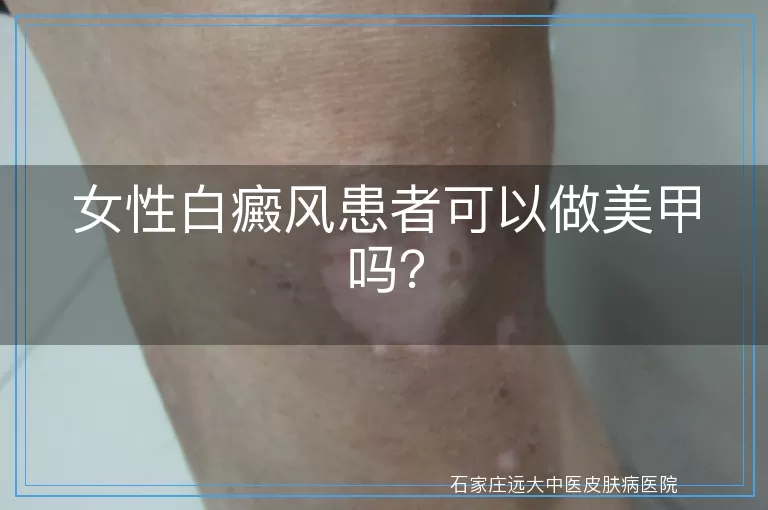 女性白癜风患者可以做美甲吗？
