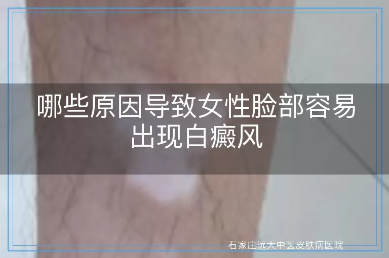 哪些原因导致女性脸部容易出现白癜风