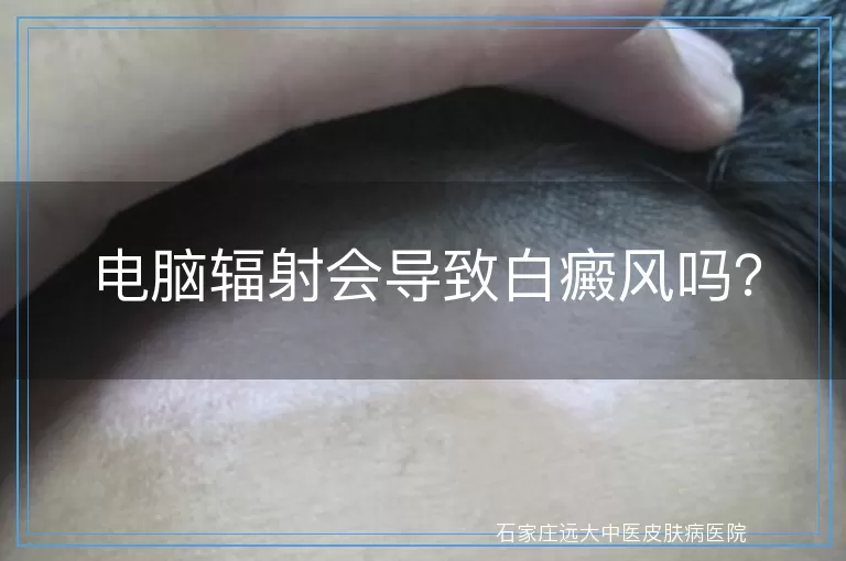 电脑辐射会导致白癜风吗？