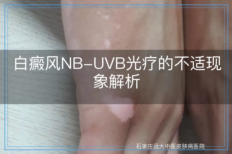 白癜风NB-UVB光疗的不适现象解析