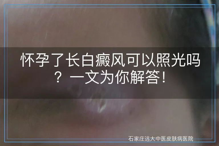 怀孕了长白癜风可以照光吗？一文为你解答！