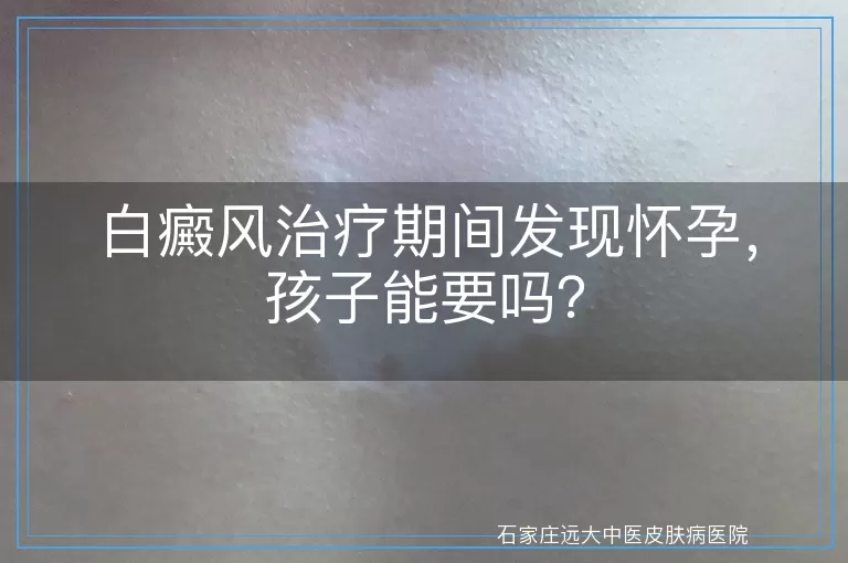 白癜风治疗期间发现怀孕，孩子能要吗？
