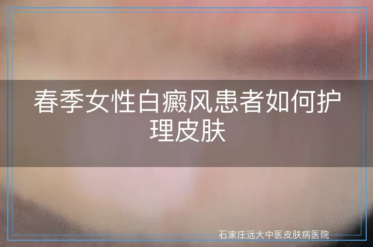 春季女性白癜风患者如何护理皮肤