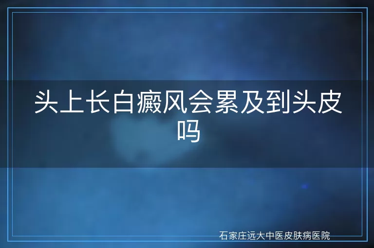 头上长白癜风会累及到头皮吗