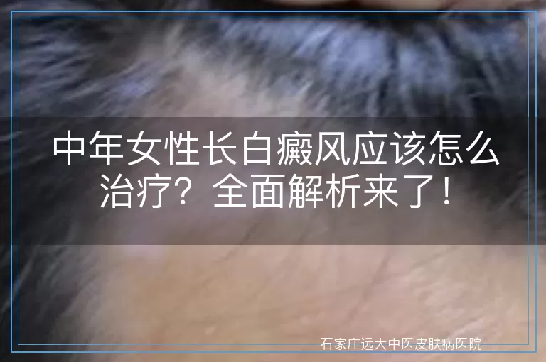 中年女性长白癜风应该怎么治疗？全面解析来了！