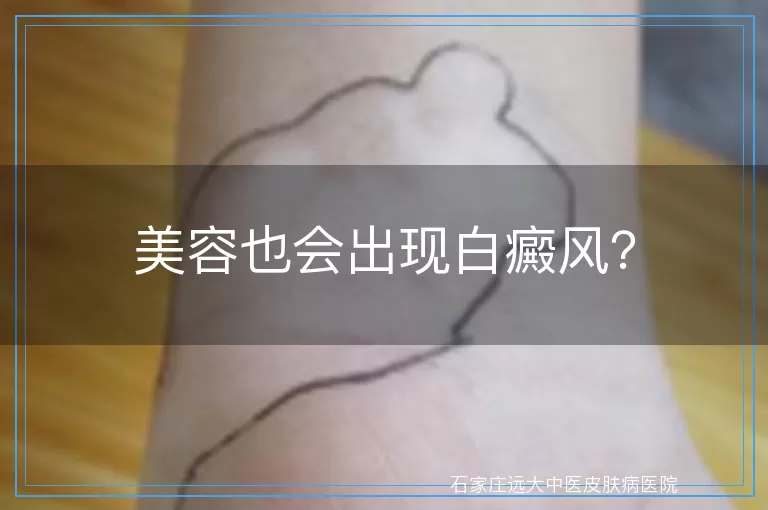 美容也会出现白癜风?