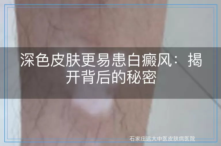 深色皮肤更易患白癜风:揭开背后的秘密