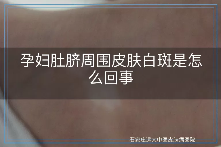 孕妇肚脐周围皮肤白斑是怎么回事