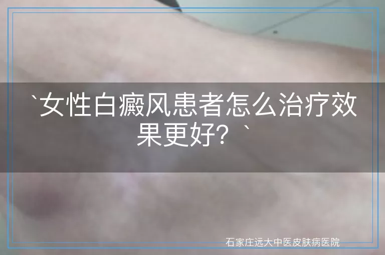 女性白癜风患者怎么治疗效果更好？