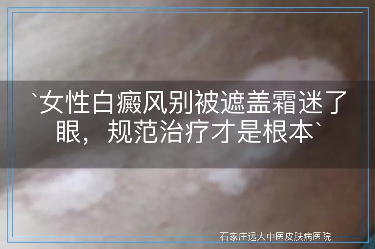女性白癜风别被遮盖霜迷了眼，规范治疗才是根本