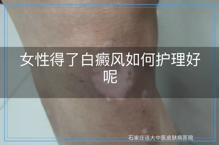 女性得了白癜风如何护理好呢