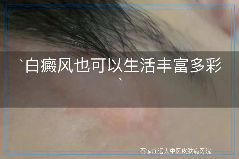 白癜风也可以生活丰富多彩