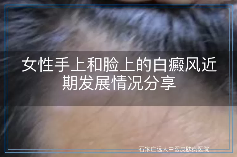 女性手上和脸上的白癜风近期发展情况分享