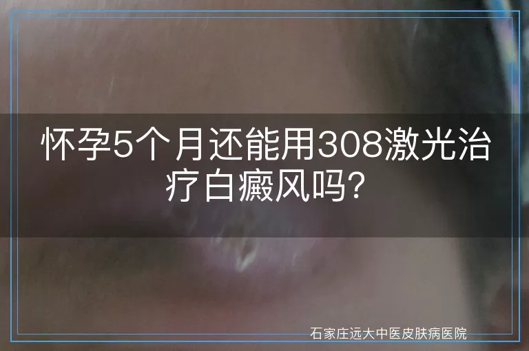 怀孕5个月还能用308激光治疗白癜风吗？