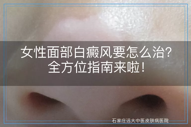 女性面部白癜风要怎么治?全方位指南来啦!