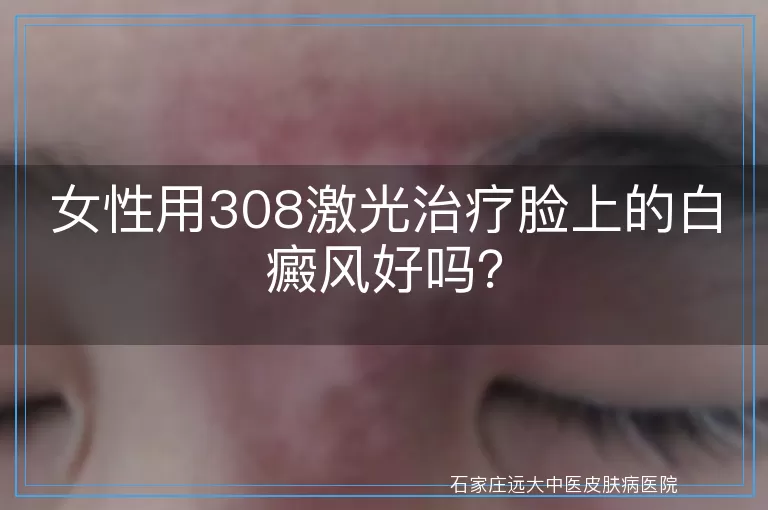 女性用308激光治疗脸上的白癜风好吗？