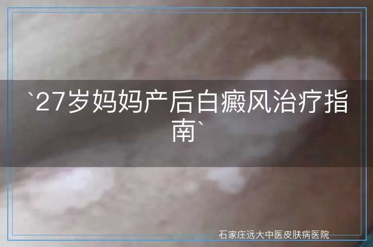 27岁妈妈产后白癜风治疗指南