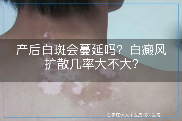 产后白斑会蔓延吗？白癜风扩散几率大不大？