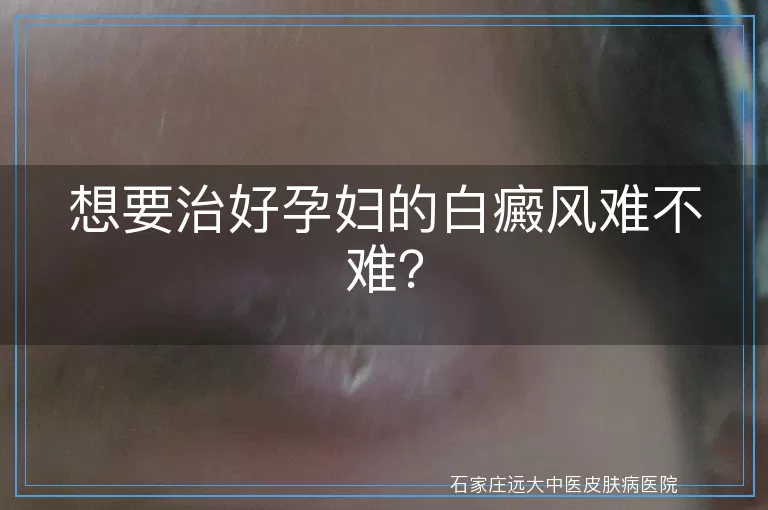 想要治好孕妇的白癜风难不难?