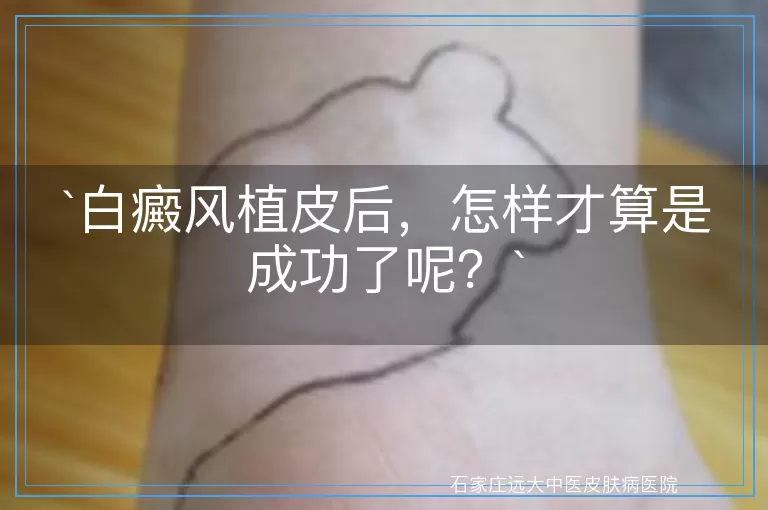 白癜风植皮后，怎样才算是成功了呢？