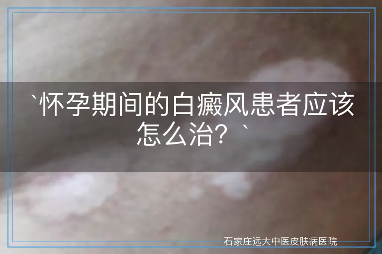 怀孕期间的白癜风患者应该怎么治？