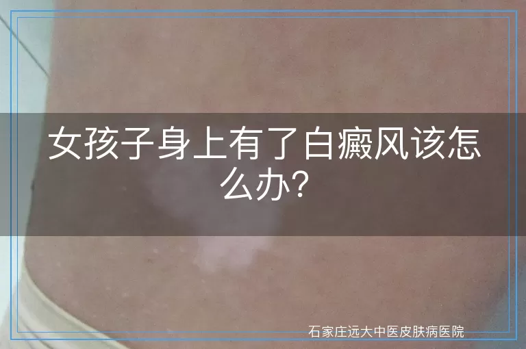 女孩子身上有了白癜风该怎么办？