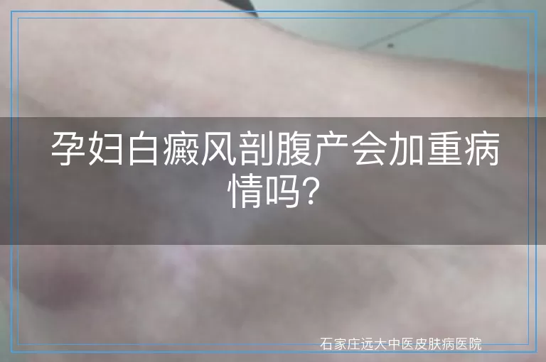 孕妇白癜风剖腹产会加重病情吗？