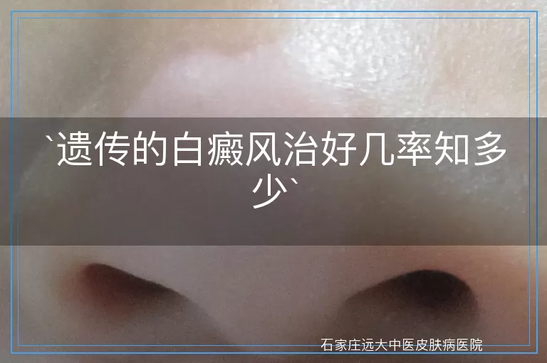 遗传的白癜风治好几率知多少