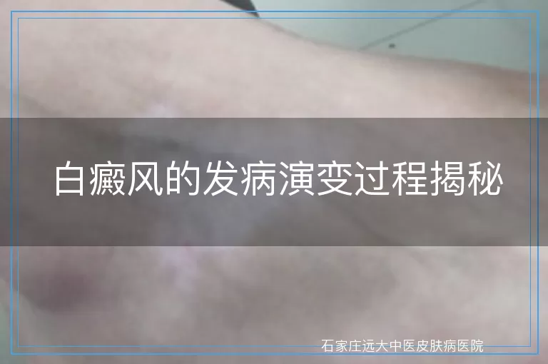 白癜风的发病演变过程揭秘