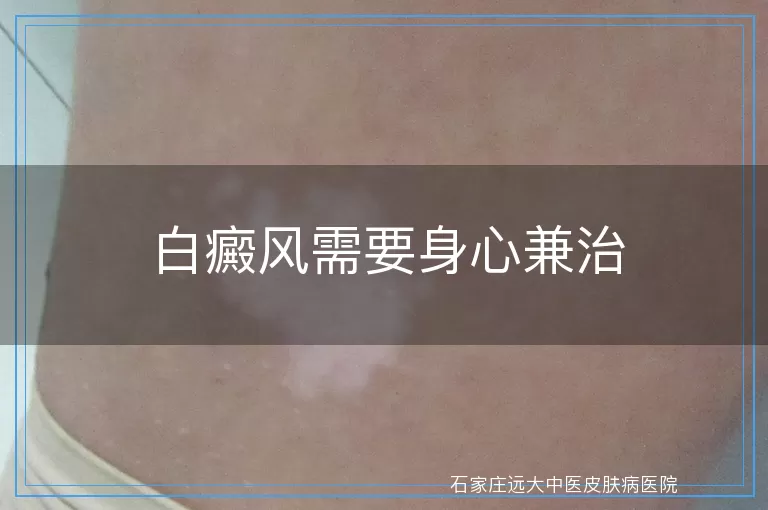 白癜风需要身心兼治
