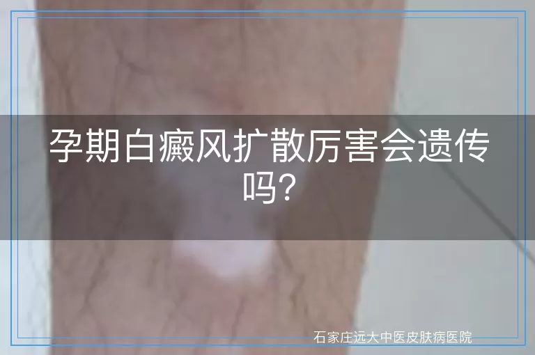 孕期白癜风扩散厉害会遗传吗？