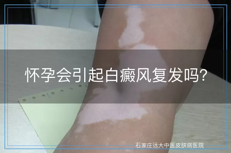 怀孕会引起白癜风复发吗？