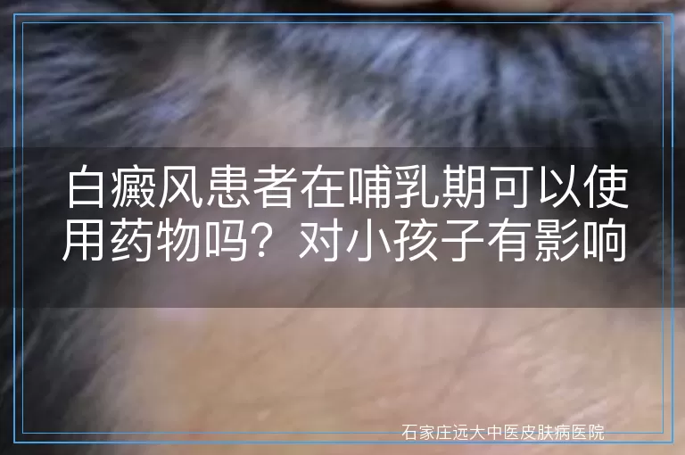 白癜风患者在哺乳期可以使用药物吗？对小孩子有影响吗？