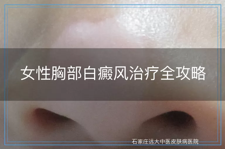 女性胸部白癜风治疗全攻略