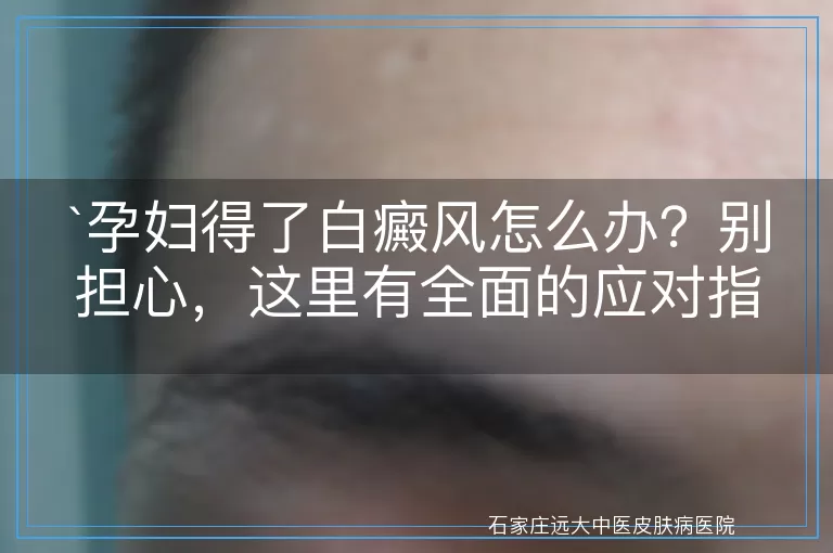 孕妇得了白癜风怎么办？别担心，这里有全面的应对指南！