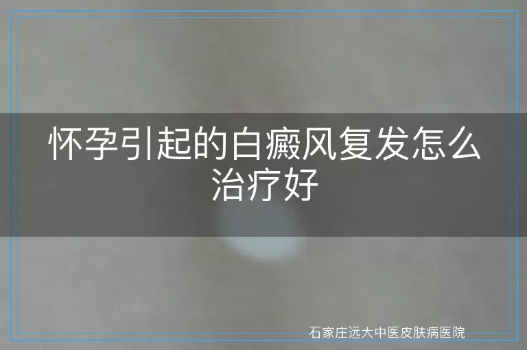怀孕引起的白癜风复发怎么治疗好