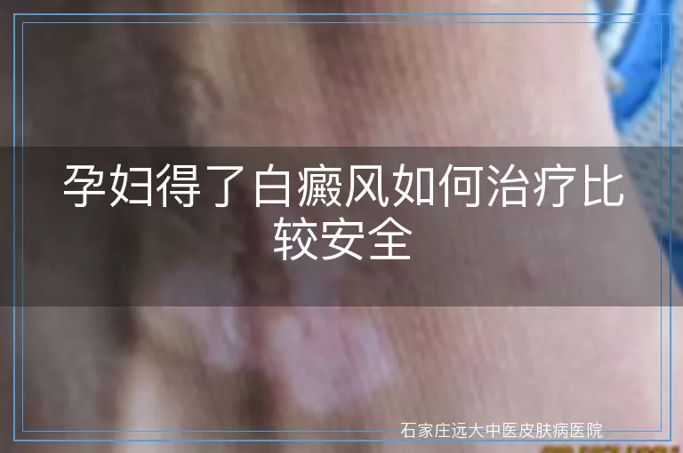 孕妇得了白癜风如何治疗比较安全