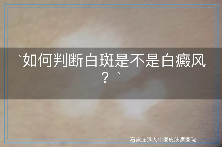 如何判断白斑是不是白癜风？