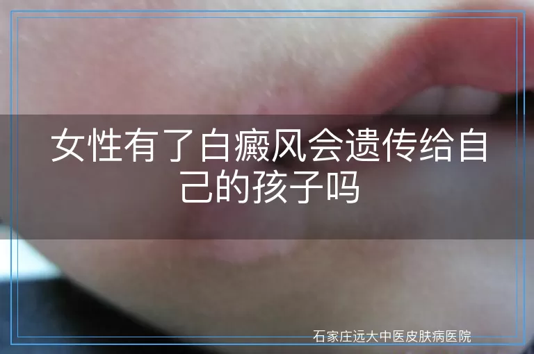 女性有了白癜风会遗传给自己的孩子吗